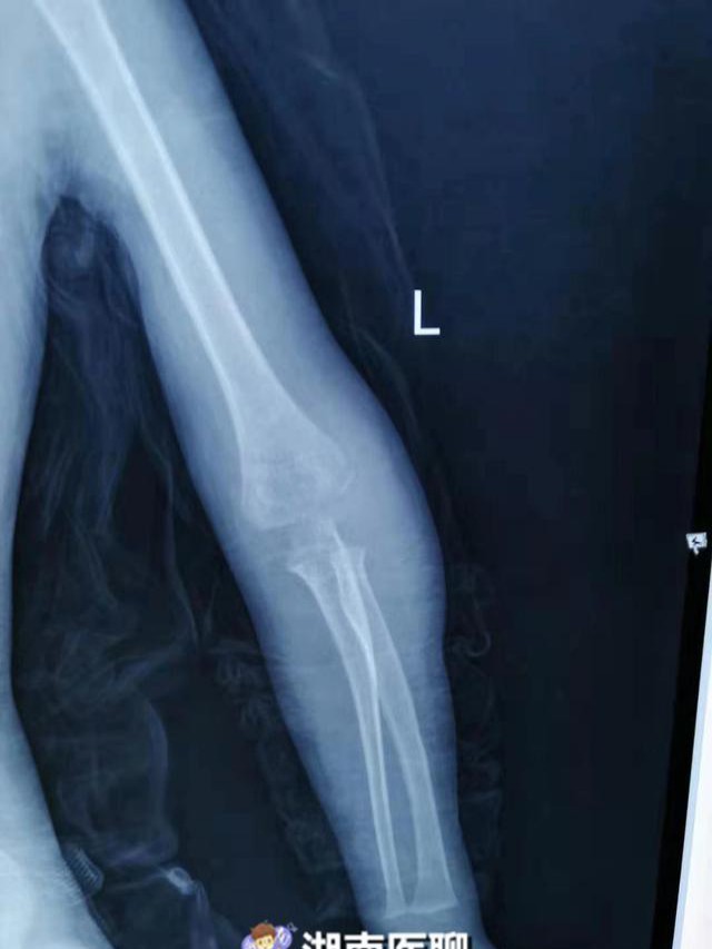 右踝骨骨折、右踝骨折：如何有效治疗与恢复？
